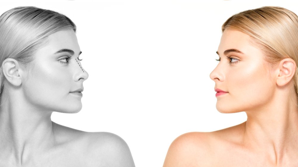 Rinoplastie: Mai mult decât o simplă îmbunătățire estetică