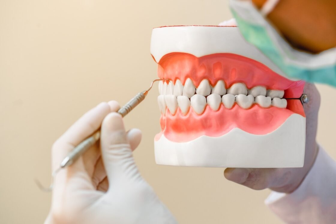 Ce este un abces gingival? Simptome, cauze și tratament