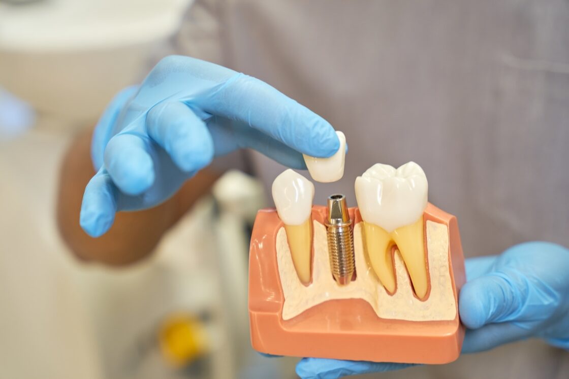 IMPLANT OR DENTAL BRIDGE?