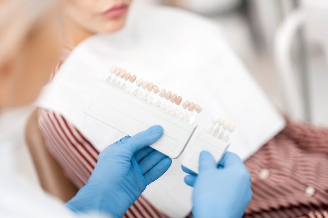 COMPOSITE LAMINATE TREATMENT (COMPOSITE LAMINATE VENEER)