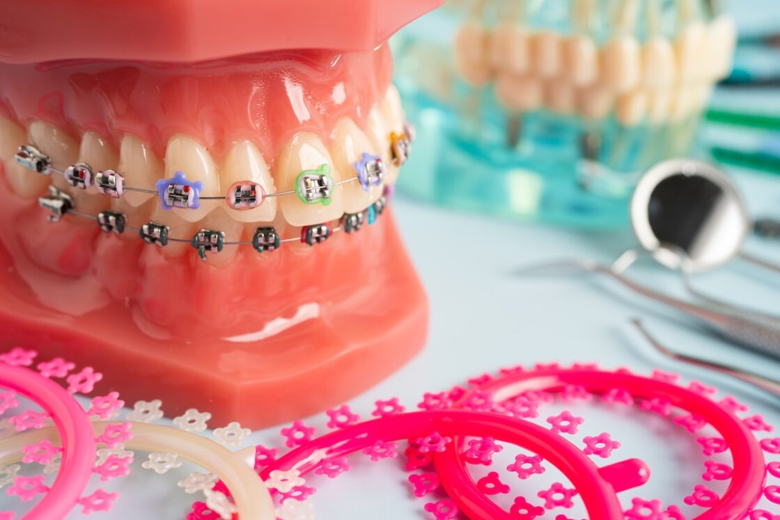 WHAT ARE THE DIFFERENCES BETWEEN CERAMIC AND METAL BRACES TREATMENT?