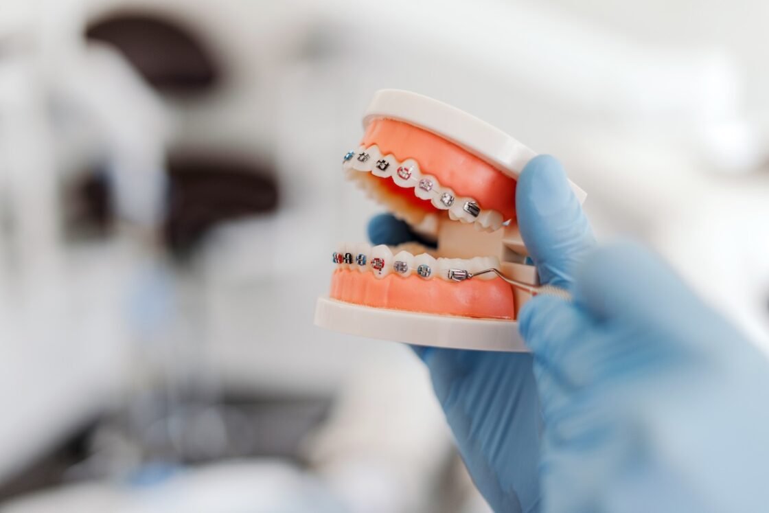 DUREAZĂ PUNEREA APARATELOR DENTARE?